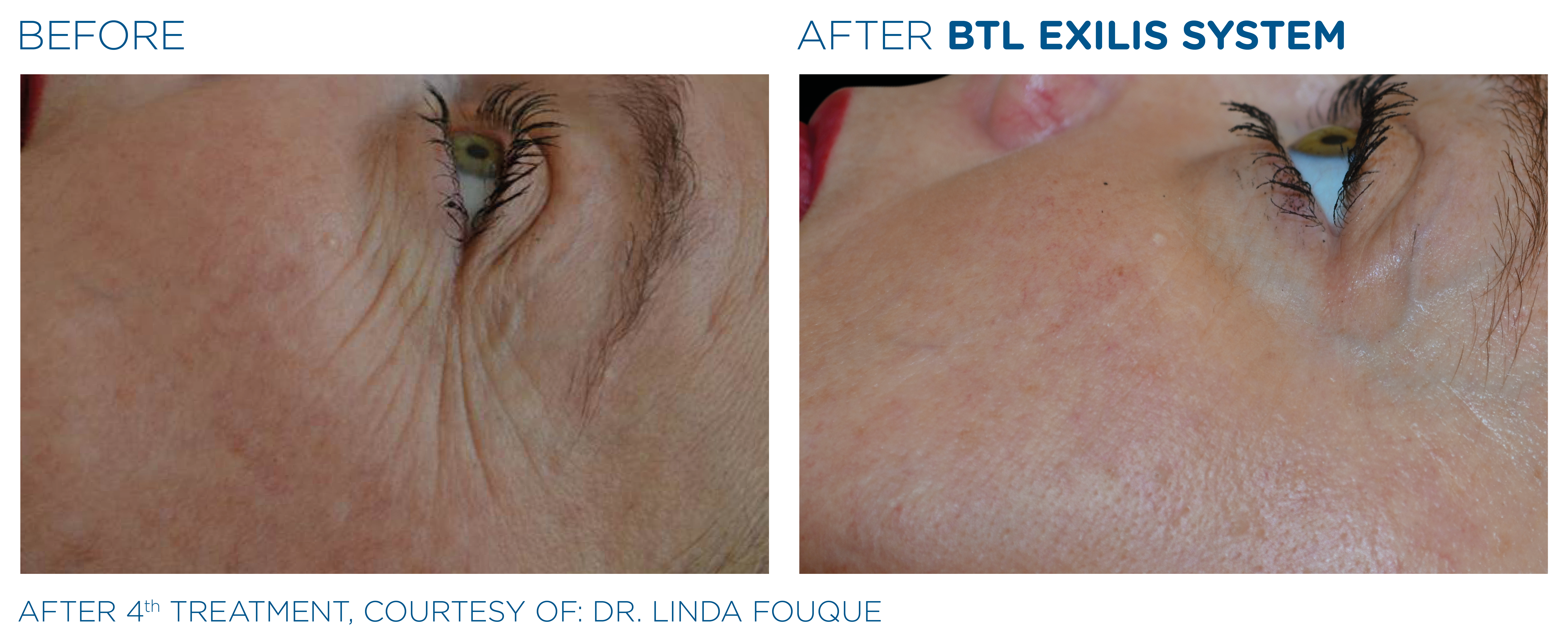 BTL Exilis előtte-utána 2